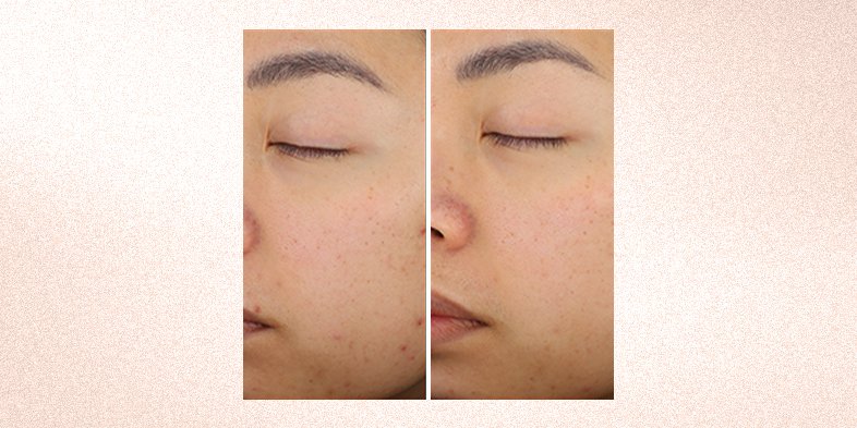 In Article Remove Dead Skin From Face Bright Reveal Exfoliating Peel